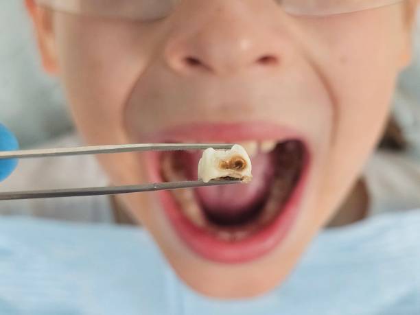 Best Emergency Root Canal Treatment in Evans City, PA